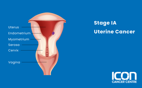 Stage 1A uterine cancer illustration
