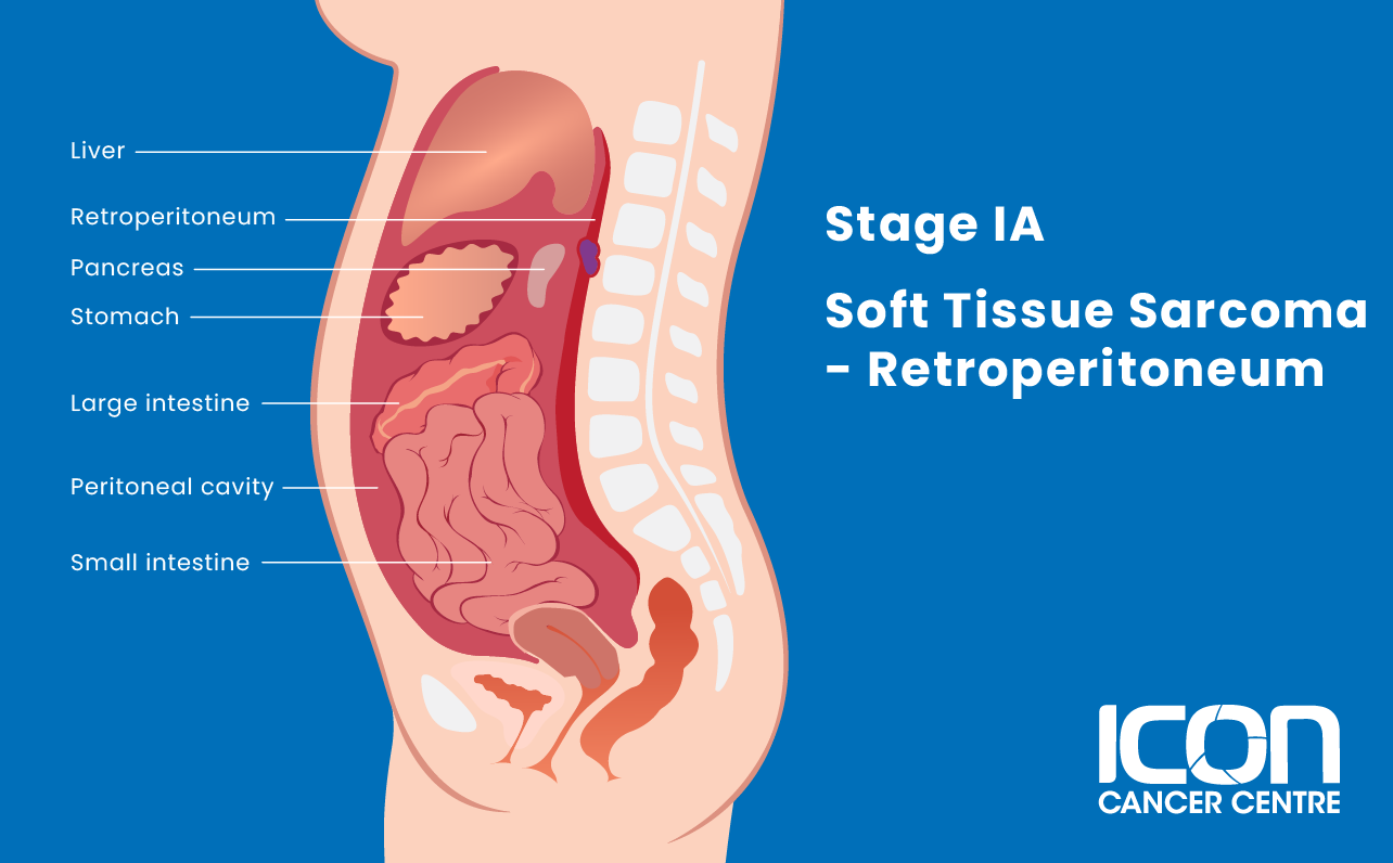 Stage IA soft tissue sarcoma in the retroperitoneum