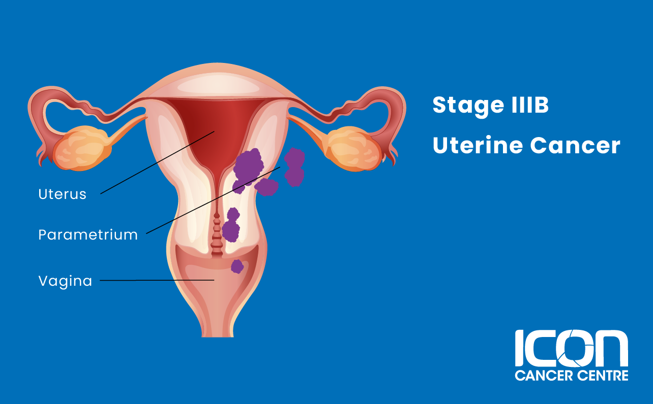 Stage IIIB uterine cancer illustration