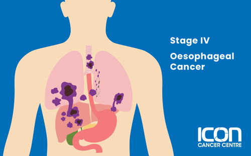 Stage IV oesophageal cancer illustration