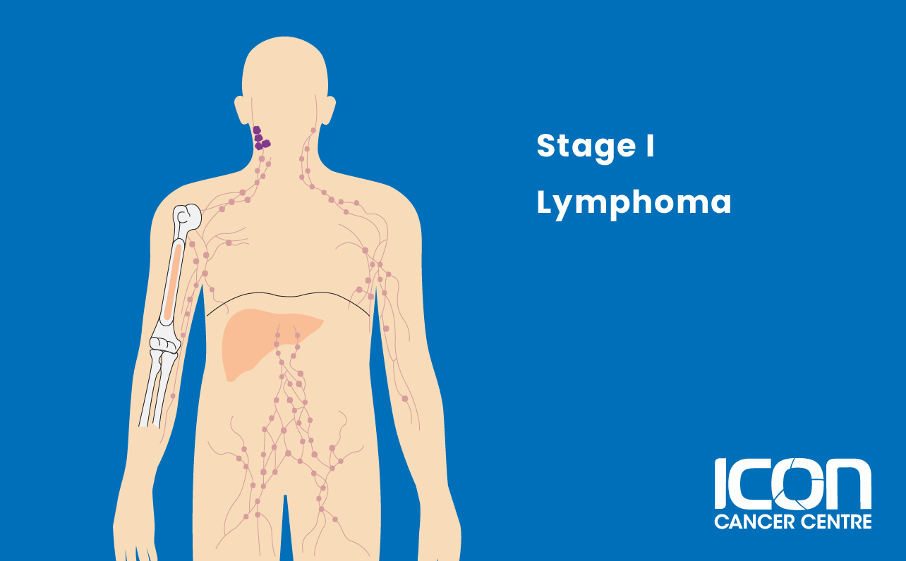 Stage 1 lymphoma illustration