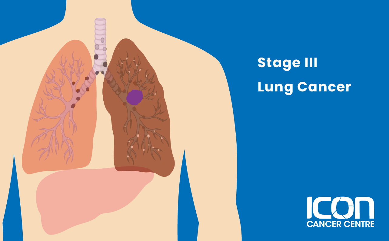 Stage III lung cancer illustration