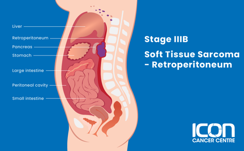 Stage IIIB soft tissue sarcoma in retroperitoneum illustration