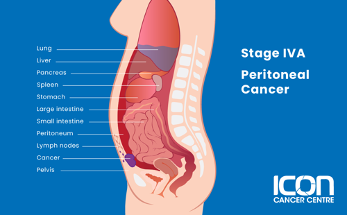 Stage IVA peritoneal cancer illustration