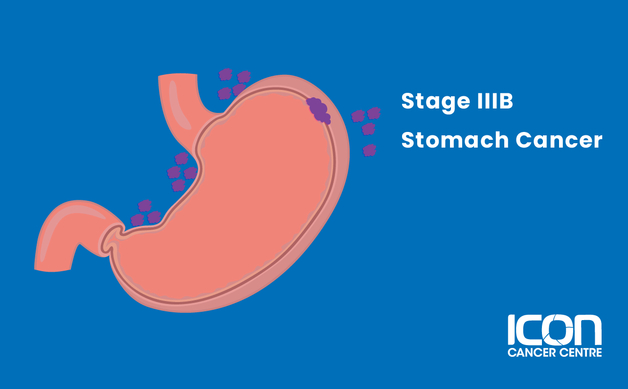 Stage IIIB stomach cancer illustration