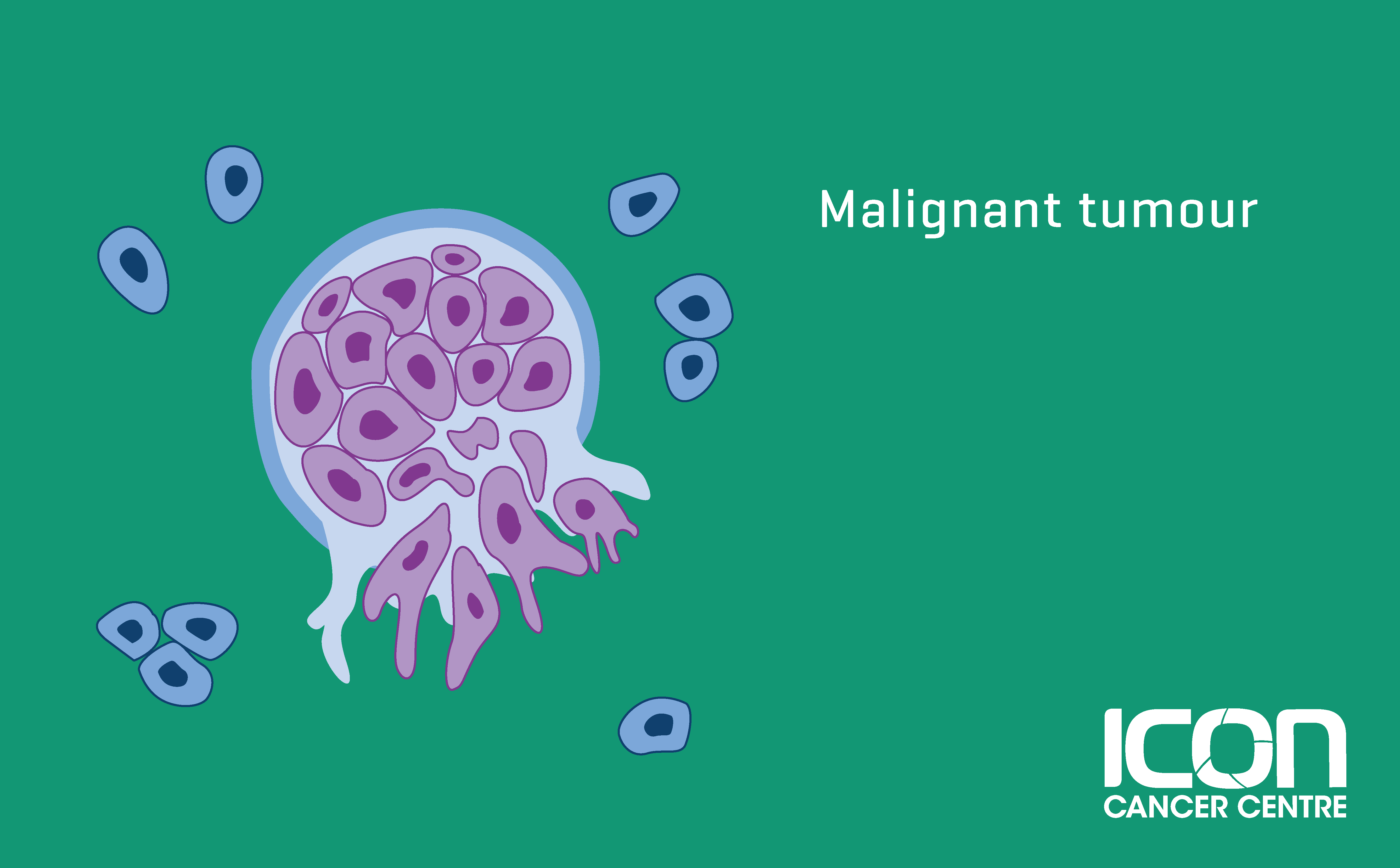 Malignant-tumour_ICC-Aus.png