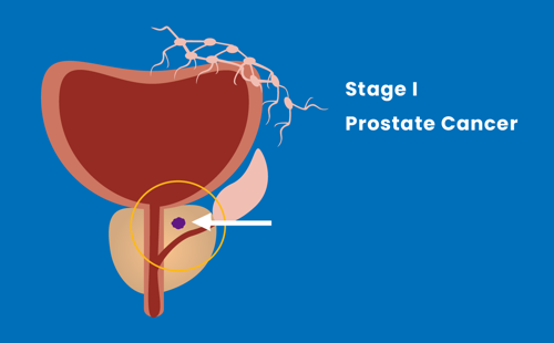 Stage I prostate cancer illustration