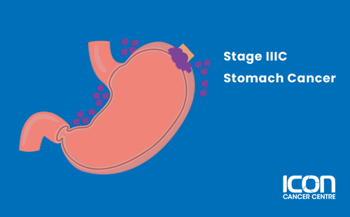 Stage IIIC stomach cancer illustration