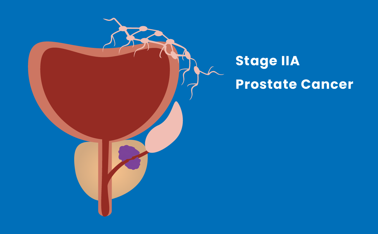 Stage IIA prostate cancer illustration