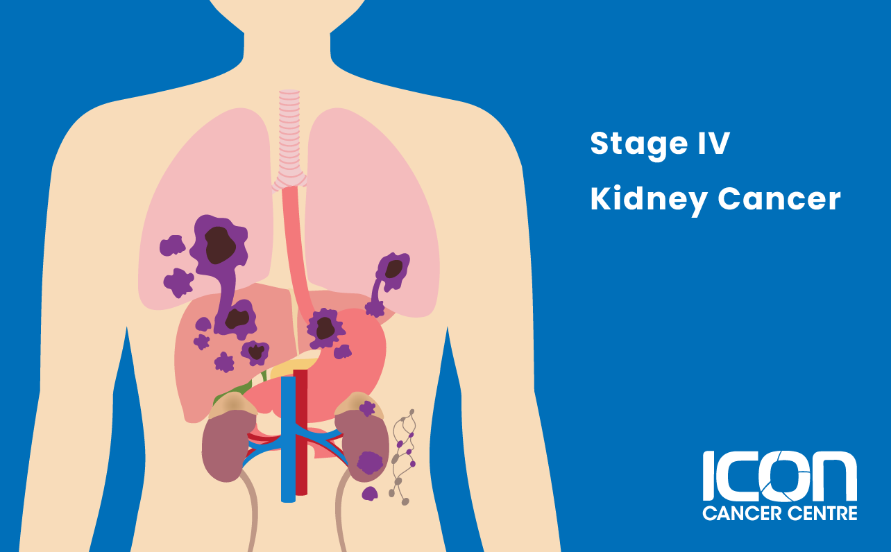 Stage IV kidney cancer illustration