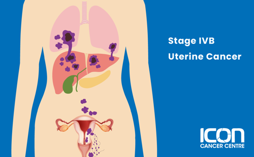 Stage IVB uterine cancer illustration